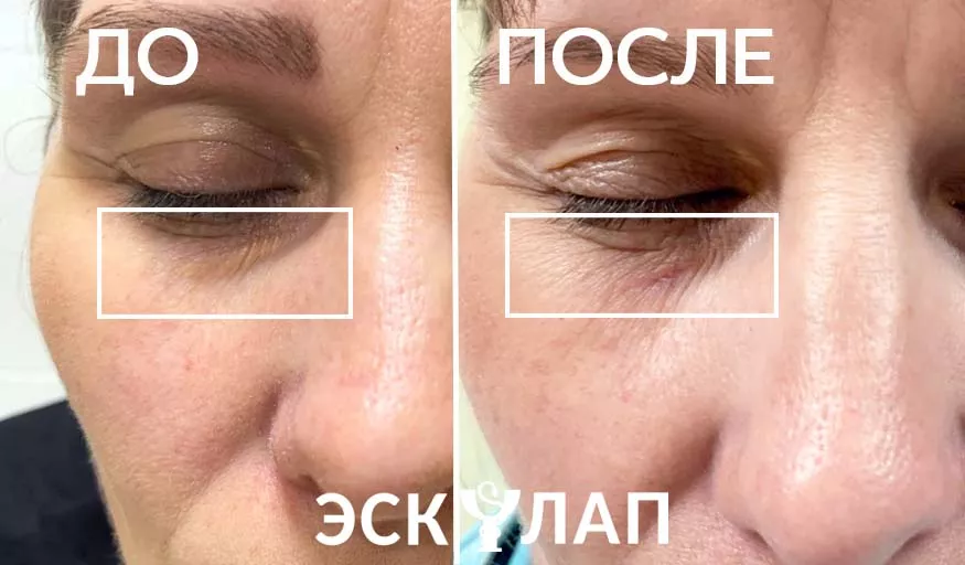Лазерное удаление новообразований.jpg